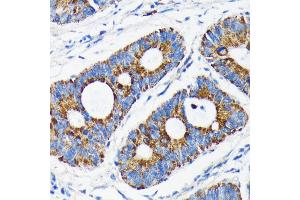 Immunohistochemistry of paraffin-embedded human colon carcinoma using Bax antibody (ABIN7265858) at dilution of 1:100 (40x lens). (BAX 抗体)