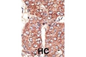 Formalin-fixed and paraffin-embedded human cancer tissue reacted with the primary antibody, which was peroxidase-conjugated to the secondary antibody, followed by AEC staining. (LRP2 抗体  (C-Term))