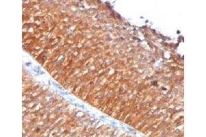 IHC testing of FFPE human bladder carcinoma with Mitochondrial antibody (GFM1 抗体)