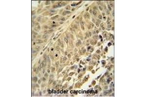 HNRNPC antibody (C-term) (ABIN654685 and ABIN2844378) immunohistochemistry analysis in formalin fixed and paraffin embedded human bladder carcinoma followed by peroxidase conjugation of the secondary antibody and DAB staining.