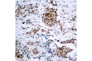 Immunohistochemistry of paraffin-embedded human breast carcinoma using Phospho-ESR1-S167 antibody (ABIN2988007). (Estrogen Receptor alpha 抗体  (pSer167))