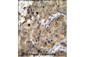 TME Antibody (C-term) (ABIN655659 and ABIN2845131) immunohistochemistry analysis in formalin fixed and paraffin embedded human breast carcinoma followed by peroxidase conjugation of the secondary antibody and DAB staining. (TMEM100 抗体  (C-Term))