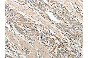 The image on the left is immunohistochemistry of paraffin-embedded Human gastric cancer tissue using ABIN7189660(ADAMTS2 Antibody) at dilution 1/25, on the right is treated with synthetic peptide. (Adamts2 抗体)