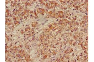 Immunohistochemistry of paraffin-embedded human liver cancer using ABIN7158499 at dilution of 1:100 (ACADL 抗体  (AA 30-260))
