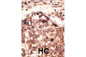 Formalin-fixed and paraffin-embedded human hepatocellular carcinoma tissue reacted with MMP8 polyclonal antibody  , which was peroxidase-conjugated to the secondary antibody, followed by AEC staining. (MMP8 抗体  (Internal Region))