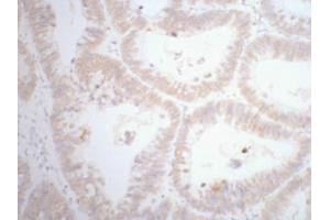 Immunohistochemistry (IHC) staining of human rectal cancer tissue, diluted at 1:200. (CDX2 抗体)