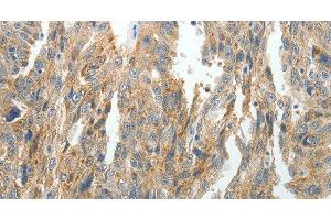 Immunohistochemistry of paraffin-embedded Human ovarian cancer tissue using PRDX5 Polyclonal Antibody at dilution 1:40 (Peroxiredoxin 5 抗体)