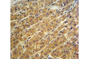 CP antibody IHC analysis in formalin fixed and paraffin embedded human hepatocarcinoma. (Ceruloplasmin 抗体  (AA 547-577))