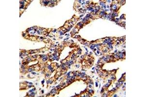 IHC analysis of FFPE human prostate carcinoma with TROP2 antibody (TACSTD2 抗体  (AA 162-190))