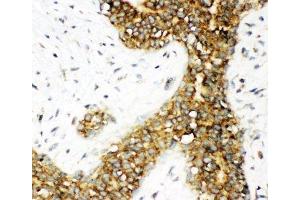 IHC-P: Calbindin antibody testing of human breast cancer tissue (CALB1 抗体  (AA 2-175))