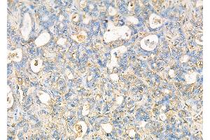 ABIN6257222 and ABIN6276028 at 1/100 staining Human liver cancer by IHC-P. (GPR17 抗体  (C-Term))