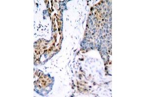 Immunohistochemistry of paraffin-embedded human breast carcinoma using Phospho-ESR1-S118 antibody (ABIN2987431). (Estrogen Receptor alpha 抗体  (pSer118))