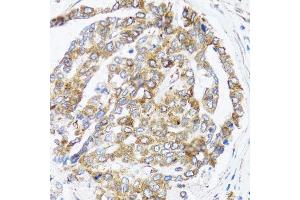 Immunohistochemistry of paraffin-embedded human liver cancer using BCAP29 antibody. (BCAP29 抗体  (AA 125-241))
