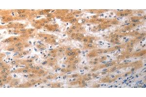 Immunohistochemistry of paraffin-embedded Human liver cancer using NQO2 Polyclonal Antibody at dilution of 1:50 (NQO2 抗体)