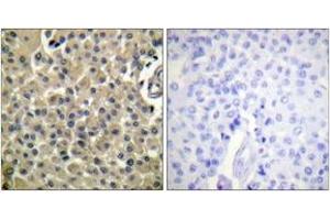 Immunohistochemistry analysis of paraffin-embedded human breast carcinoma tissue, using CD227/Mucin 1 (Ab-1243) Antibody. (MUC1 抗体  (AA 1204-1253))