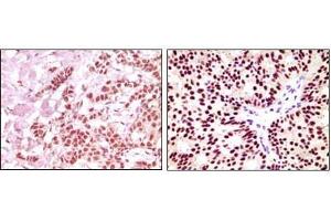 Immunohistochemical analysis of paraffin-embedded human breast carcinoma, using ER-alpha antibody showing nuclear expression with DAB staining. (Estrogen Receptor alpha 抗体  (AA 410-592))