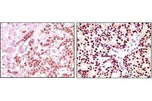 Immunohistochemical analysis of paraffin-embedded human breast carcinoma, using ER-alpha antibody showing nuclear expression with DAB staining.