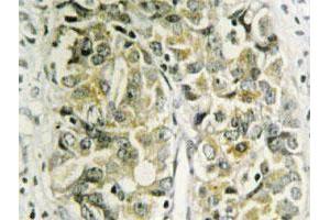 Immunohistochemical analysis of paraffin-embedded human prostate cancer tissue using LGALS8 polyclonal antibody . (LGALS8 抗体)