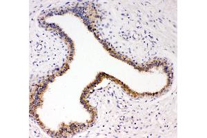 Anti-TrkC antibody,  IHC(P) IHC(P): Human Mammary Cancer Tissue