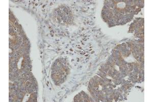 IHC-P Image Immunohistochemical analysis of paraffin-embedded human endo mitral ovarian cancer, using PPM1K, antibody at 1:100 dilution. (PPM1K 抗体)