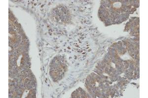 IHC-P Image Immunohistochemical analysis of paraffin-embedded human endo mitral ovarian cancer, using PPM1K, antibody at 1:100 dilution. (PPM1K 抗体)