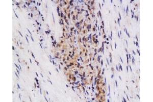 Formalin-fixed and paraffin embedded human colon carcinoma labeled with Anti-SynCAM/TSLC1 Polyclonal Antibody, Unconjugated  at 1:200 followed by conjugation to the secondary antibody and DAB staining. (CADM1 抗体  (AA 365-442))