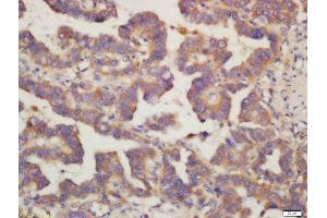 Formalin-fixed and paraffin embedded human lung carcinoma labeled with Rabbit Anti-PIG3 Polyclonal Antibody, Unconjugated (ABIN763046) at 1:200 followed by conjugation to the secondary antibody and DAB staining (MRPL41 抗体  (AA 151-250))