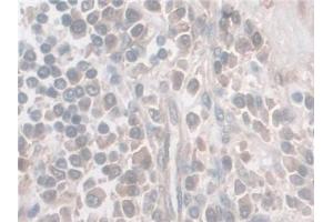 Detection of Nesp2 in Human Prostate cancer Tissue using Polyclonal Antibody to Nesprin 2 (Nesp2)