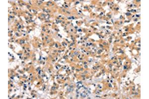The image on the left is immunohistochemistry of paraffin-embedded Human thyroid cancer tissue using ABIN7190538(EID3 Antibody) at dilution 1/15, on the right is treated with synthetic peptide. (EID3 抗体)