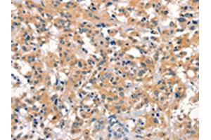 The image on the left is immunohistochemistry of paraffin-embedded Human thyroid cancer tissue using ABIN7190538(EID3 Antibody) at dilution 1/15, on the right is treated with synthetic peptide.