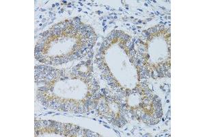 Immunohistochemistry of paraffin-embedded human colon carcinoma using DNAJC19 antibody.