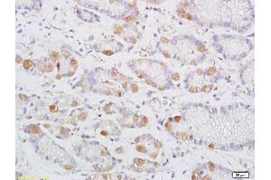 Formalin-fixed and paraffin embedded human colon carcinoma labeled with Anti-DENND2D Polyclonal Antibody, Unconjugated (ABIN1385457) at 1:200 followed by conjugation to the secondary antibody and DAB staining (DENND2D 抗体  (AA 200-238))