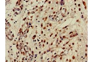 Immunohistochemistry of paraffin-embedded human lung cancer using ABIN7146768 at dilution of 1:100 (CPB2 抗体  (AA 225-372))