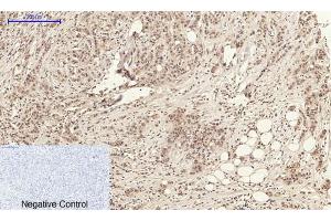 Immunohistochemical analysis of paraffin-embedded Human-kidney-cancer tissue. (Annexin a1 抗体  (AA 130-180))