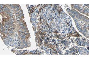 ABIN6277681 at 1/100 staining Human cervical cancer tissue by IHC-P. (OCA2 抗体  (N-Term))