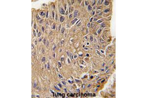 Formalin-fixed and paraffin-embedded human lung carcinomareacted with ANTXR1 polyclonal antibody , which was peroxidase-conjugated to the secondary antibody, followed by AEC staining. (ANTXR1 抗体  (Tyr382))