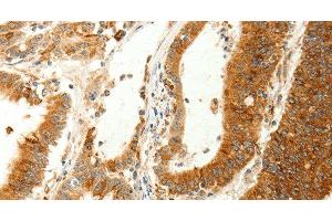 Immunohistochemistry of paraffin-embedded Human colon cancer using RARRES1 Polyclonal Antibody at dilution of 1:60 (RARRES1 抗体)