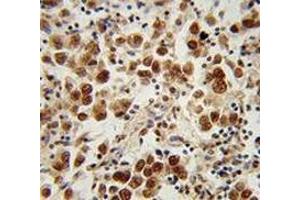 Immunohistochemistry analysis in human testis carcinoma (Formalin-fixed, Paraffin-embedded) using SOHLH1 / TEB2  Antibody (N-term), followed by peroxidase conjugation of the secondary antibody and DAB staining. (SOHLH1 抗体  (N-Term))