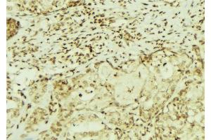 ABIN6272900 at 1/100 staining Human breast cancer tissue by IHC-P. (CEMIP 抗体  (C-Term))