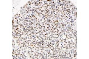Immunohistochemistry analysis of paraffin-embedded human ovarian cancerusing ADRA1B (ABIN7072974) at dilution of 1: 1200
