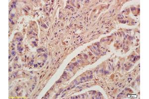 Formalin-fixed and paraffin embedded human colon carcinoma labeled with Anti-KLF2 Polyclonal Antibody, Unconjugated (ABIN680473) at 1:200, followed by conjugation to the secondary antibody and DAB staining (KLF2 抗体  (AA 251-355))