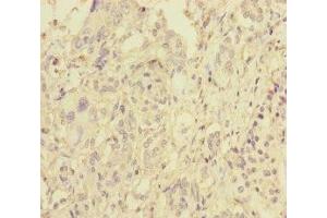 Immunohistochemistry of paraffin-embedded human pancreatic cancer using ABIN7145609 at dilution of 1:100 (Pallidin 抗体  (AA 1-170))