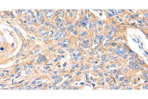 Immunohistochemistry of paraffin-embedded Human esophagus cancer using MVP Polyclonal Antibody at dilution of 1:30 (MVP 抗体)