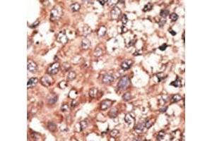 IHC analysis of FFPE human hepatocarcinoma tissue stained with the BMP5 antibody (BMP5 抗体  (AA 16-46))