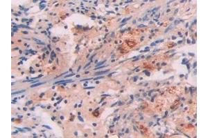Detection of SAP in Human Lung cancer Tissue using Polyclonal Antibody to Serum Amyloid P Component (SAP)