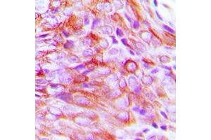Immunohistochemical analysis of SMIT1 staining in human breast cancer formalin fixed paraffin embedded tissue section. (SLC5A3 抗体  (Center))