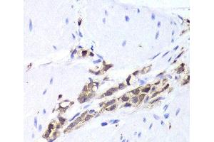 Immunohistochemistry of paraffin-embedded Human gastric cancer using TPPP3 Polyclonal Antibody at dilution of 1:100 (40x lens). (TPPP3 抗体)