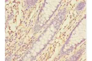 Immunohistochemistry of paraffin-embedded human colon cancer using ABIN7172004 at dilution of 1:100 (TXNDC5 抗体  (AA 1-324))