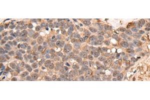 Immunohistochemistry of paraffin-embedded Human thyroid cancer tissue using ATRIP Polyclonal Antibody at dilution of 1:40(x200) (ATRIP 抗体)