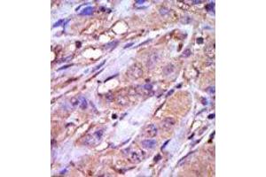 Formalin-fixed and paraffin-embedded human cancer tissue reacted with the primary antibody, which was peroxidase-conjugated to the secondary antibody, followed by DAB staining. (CK1 epsilon 抗体  (C-Term))